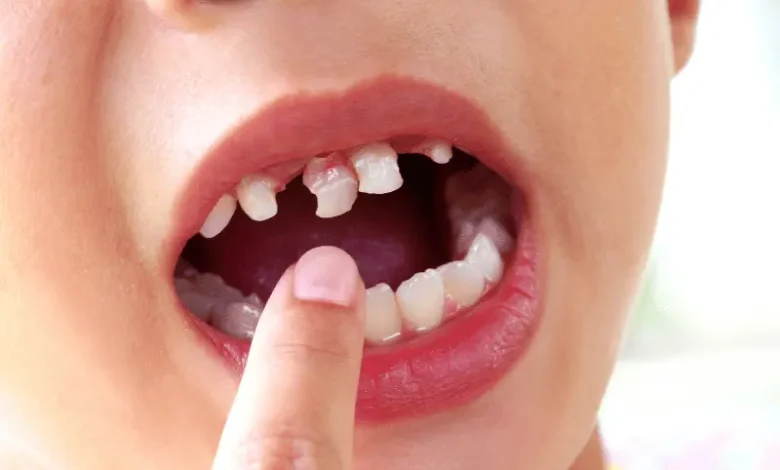 Signs Your Child May Have Early Tooth Decay