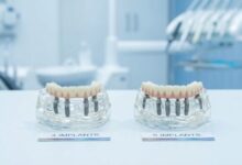 All-on-4 and All-on-6 Dental Implants in Antalya